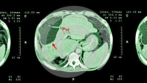 CT scan of upper abdomen : show abnormal mass at liver ( Liver cancer )