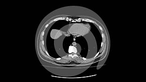 Ct scan of upper abdomen top view