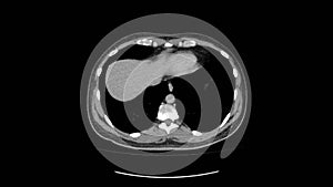 Ct scan of upper abdomen top view
