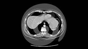 Ct scan of upper abdomen top view