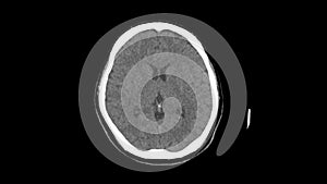 Ct scan of upper brain of head top view