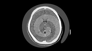 Ct scan of upper brain of head top view