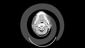 Ct scan of upper neck top view smooth motion