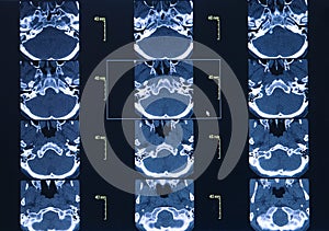 CT Scan Whole Abdomen