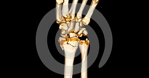 CT scan of wrist joint 3D rendering for diagnosis wrist joint pain