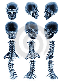 CT scan & x28; Computed tomography & x29; with 3D graphic show normal human skull and cervical spine