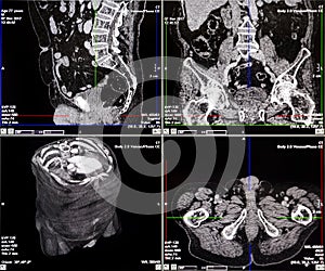 CT scans of human spine