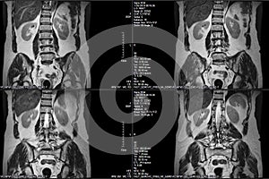 CT scans of human spine on a ultrasound computer monitor