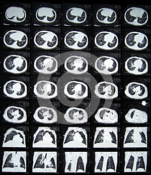 CT of thorax photo