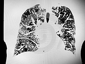 CT of the thorax showing severe COPD photo