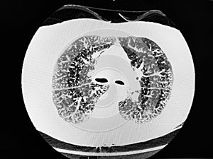 CT of the thorax showing severe COPD photo