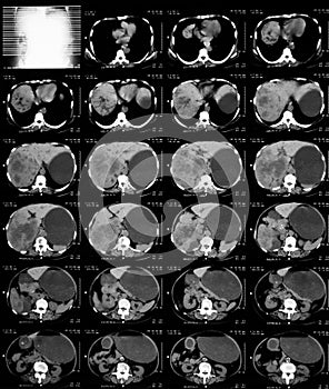 CT of upper abdomen.