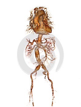 CTA abdominal aorta 3D rendering image.