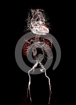 CTA abdominal aorta 3D rendering image  with stent graft