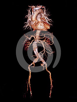 CTA abdominal aorta 3D rendering image with stent graft .