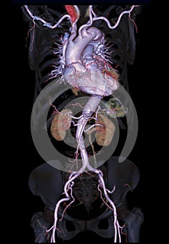 CTA abdominal aorta 3D rendering image  on transparent skeletal