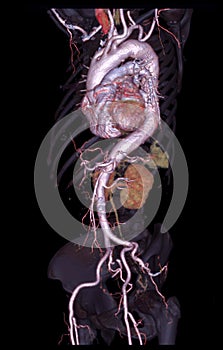 CTA abdominal aorta 3D rendering image  on transparent skeletal