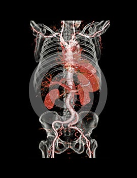 CTA abdominal aorta 3D rendering image
