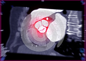 CTA of the aorta showing aortic valve