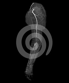 CTA brachial artery or CT scan of upper extremity  3D rendering image