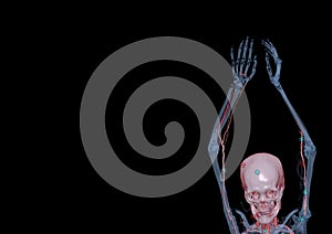 CTA brachial artery or CT scan of upper extremity or the Arm 3d rendering image on black background