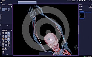 CTA brachial artery or CT scan of upper extremity or the Arm 3d rendering image on blurred screen photo