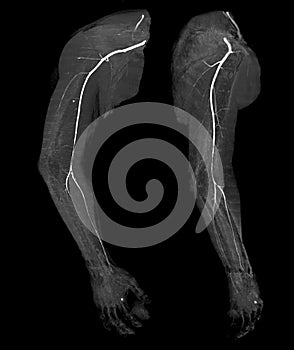 CTA brachial artery or CT scan of upper extremity  3D rendering image photo