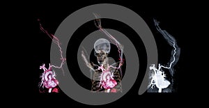 CTA brachial artery or CT scan Vessel of upper extremity .