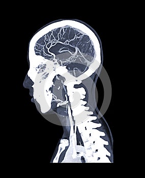 CTA brain or CT angiography of the brain sagittal mip view.