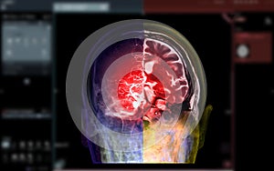 CTA brain and mri brain fusion image .