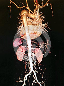 CTA computed tomography angiographphy3D take photo from film x-ray of whole aorta photo