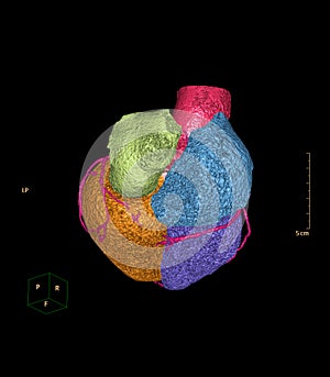 CTA Coronary artery 3D rendering image .