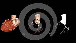 CTA coronary artery 3D rendering is a diagnostic imaging technique capturing detailed visuals of the heart's blood vessels in photo