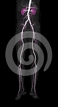 CTA femoral artery run off  3D rendering image.