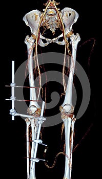 CTA femoral artery run off  3D rendering image