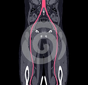 CTA femoral artery run off image of femoral artery for diagnostic  Acute or Chronic Peripheral Arterial Disease