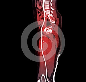 CTA femoral artery run off image of femoral artery for diagnostic  Acute or Chronic Peripheral Arterial Disease