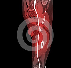 CTA femoral artery run off image of femoral artery for diagnostic  Acute or Chronic Peripheral Arterial Disease