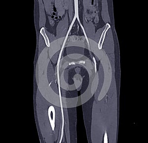 CTA femoral artery run off image of femoral artery for diagnostic  Acute or Chronic Peripheral Arterial Disease