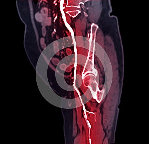 CTA femoral artery run off image of femoral artery for diagnostic  Acute or Chronic Peripheral Arterial Disease