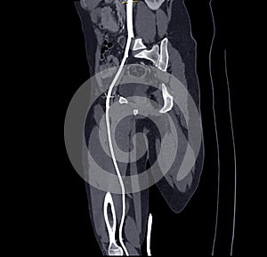 CTA femoral artery run off image of femoral artery for diagnostic  Acute or Chronic Peripheral Arterial Disease