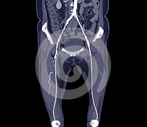 CTA femoral artery run off image of femoral artery for diagnostic  Acute or Chronic Peripheral Arterial Disease