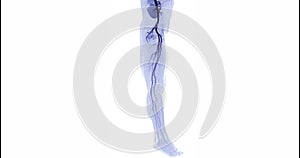 CTA femoral artery run off image of femoral artery for diagnostic Acute or Chronic Peripheral Arterial Disease