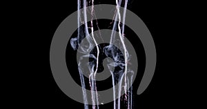 CTA femoral artery run off image of femoral artery for diagnostic Acute or Chronic Peripheral Arterial Disease