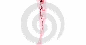 CTA femoral artery run off image of femoral artery for diagnostic Acute or Chronic Peripheral Arterial Disease