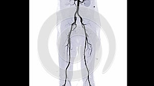 CTA femoral artery run off image of femoral artery for diagnostic Acute or Chronic Peripheral Arterial Disease