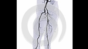 CTA femoral artery run off image of femoral artery for diagnostic Acute or Chronic Peripheral Arterial Disease