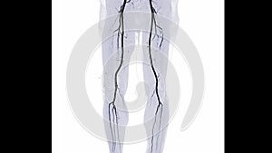 CTA femoral artery run off image of femoral artery for diagnostic Acute or Chronic Peripheral Arterial Disease