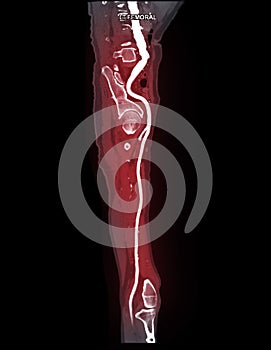 CTA femoral artery run  off MPR curve  showing Left  femoral artery for diagnostic  Acute or Chronic Peripheral Arterial Disease
