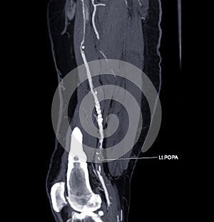 CTA femoral artery run  off MPR curve  showing Left  femoral artery for diagnostic  Acute or Chronic Peripheral Arterial Disease